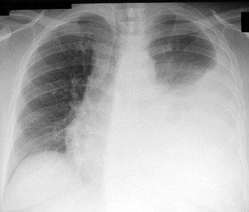 What+is+Pneumothorax+xray