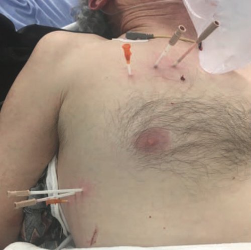 Capnospot+removes+guesswork